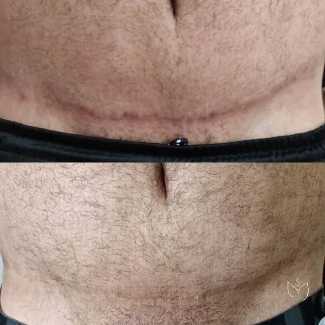 Camuflagem de cicatriz abdominal antes e depois