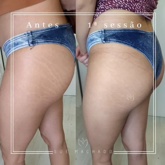 Camuflagem de estrias antes e depois da 1ª sessão