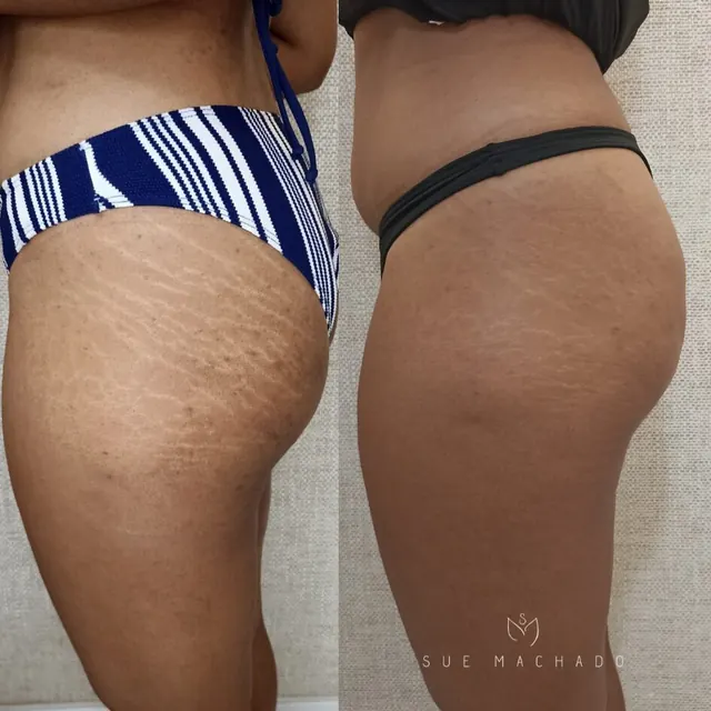 Camuflagem de estrias antes e depois