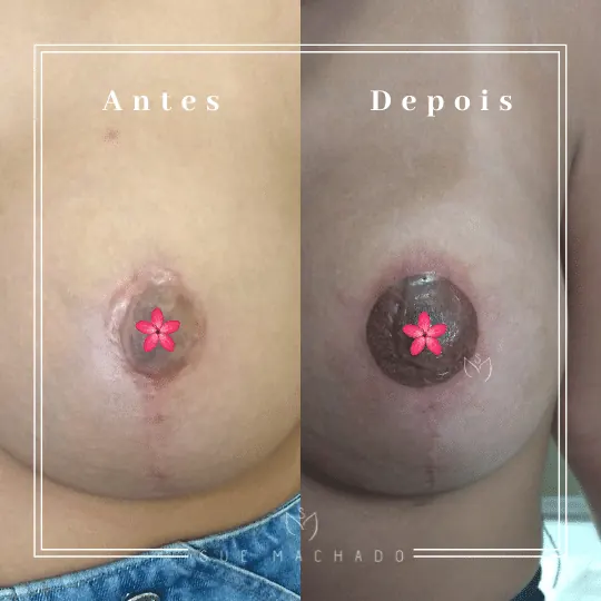 Harmonização de aréolas antes e depois