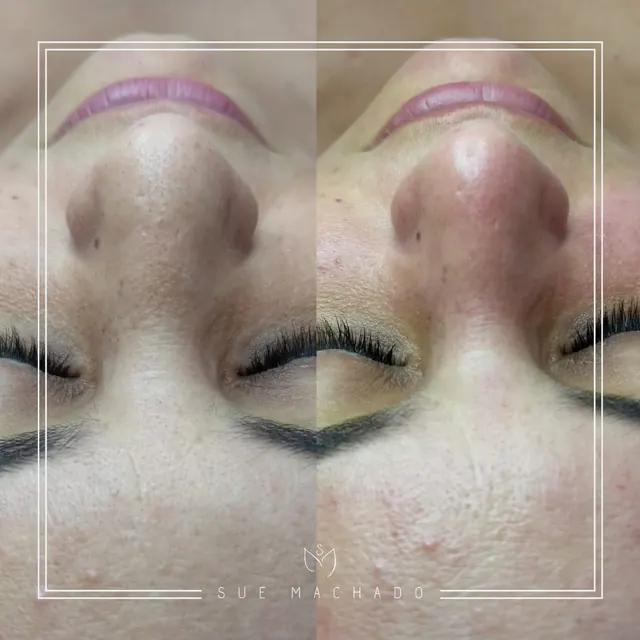 Limpeza de pele antes e depois