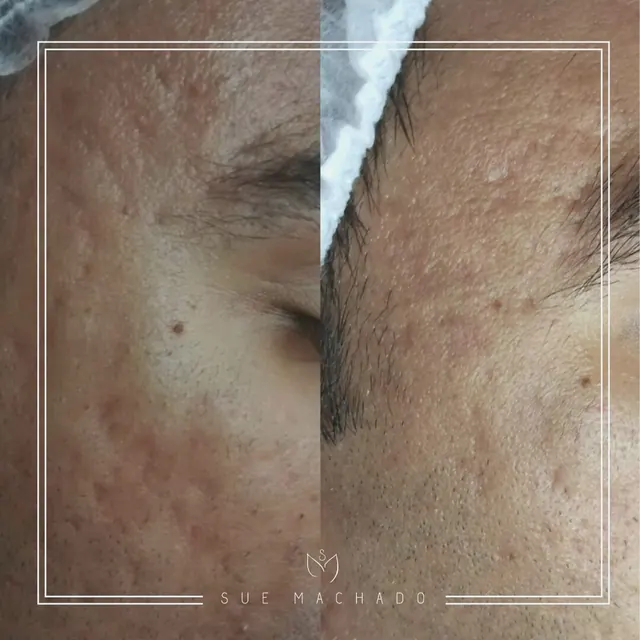 Microagulhamento facial antes e depois