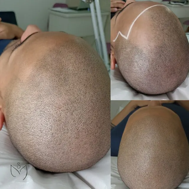Micropigmentação capilar antes e depois