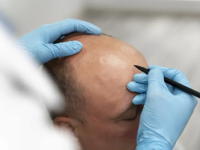 Micropigmentação Capilar em Brasília