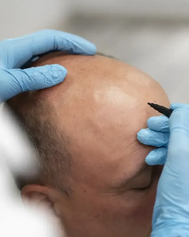 Marcação da linha frontal antes da micropigmentação capilar masculina em Brasília