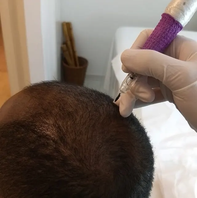 Sessão de micropigmentação capilar com dermógrafo no consultório em Brasília