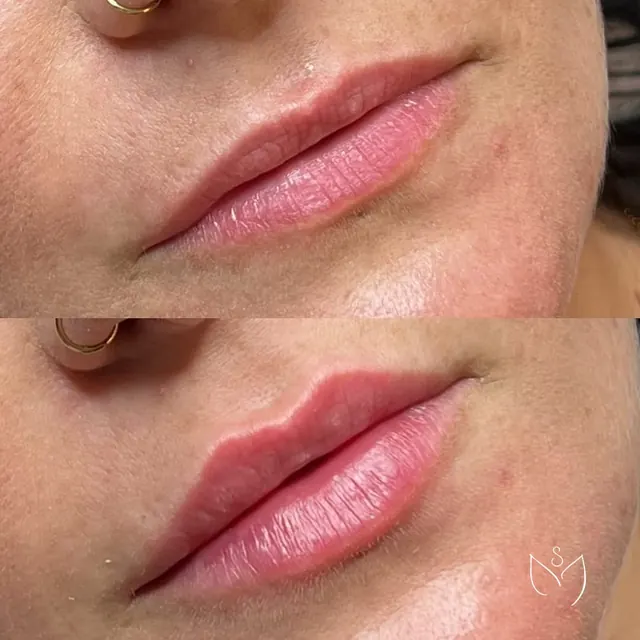 Preenchimento labial antes e depois