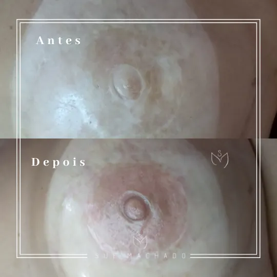 Reconstrução de aréolas antes e depois